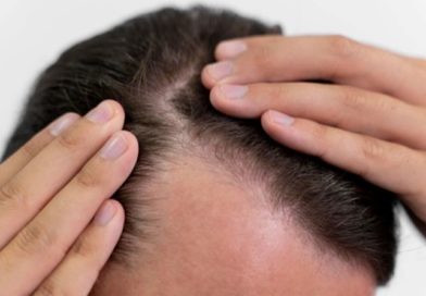 Is the Cost of an FUE Hair Transplant Worth It? Factors to Consider